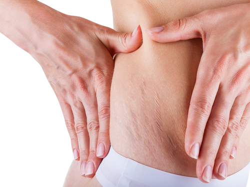 How Laser Stretch Mark Reduction Works