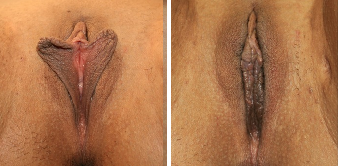 Clitoral Hood Reduction and Labiaplasty Minora.