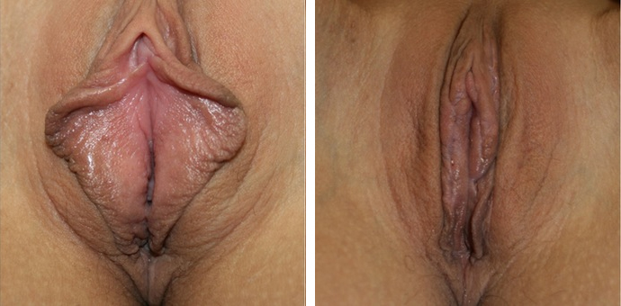 Labiaplasty Minora