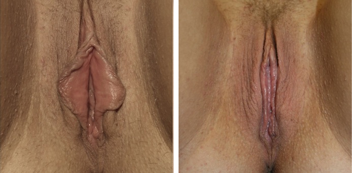 Labiaplasty Minora