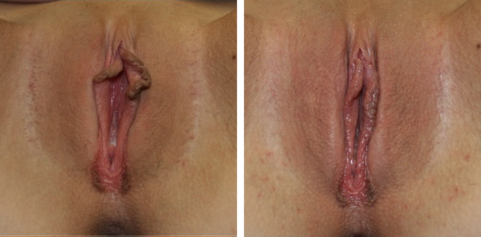 Labiaplasty
