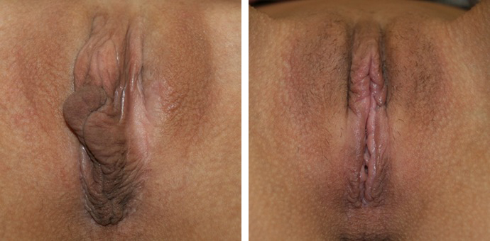 Successful Clitoral Hood Reduction Surgery In India