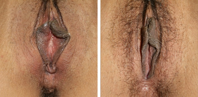 Labiaplasty Minora and Clitoral Hood Reduction