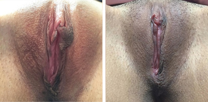 Labiaplasty Minora