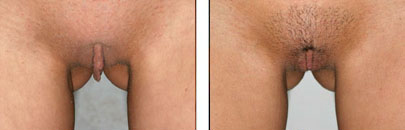 Clitoral Hood Reduction and Labiaplasty