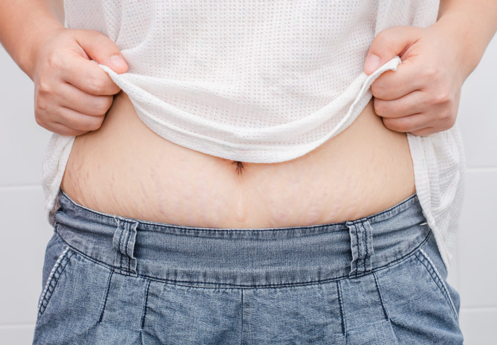 Mommy Makeovers: Beyond the Tummy Tuck