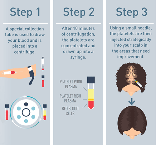 Steps of PRP Hair Therapy Treatment