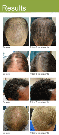 PRP Hair Restoration Los Angeles Results