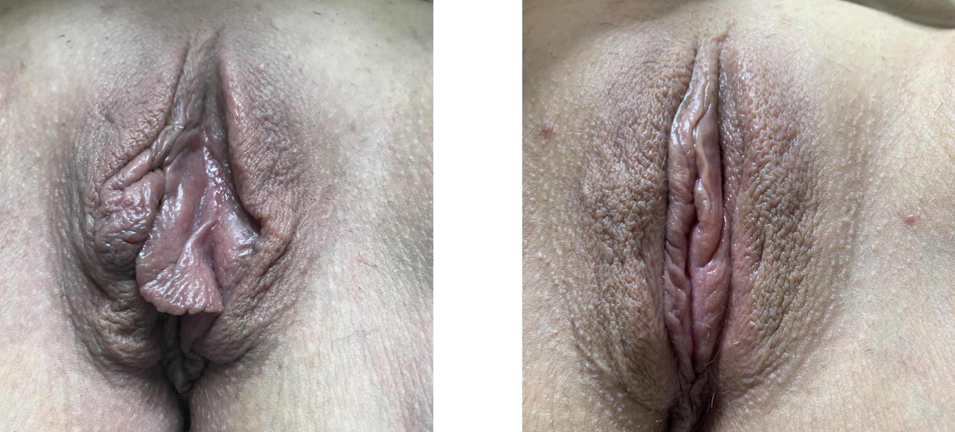 Labiaplasty Minora