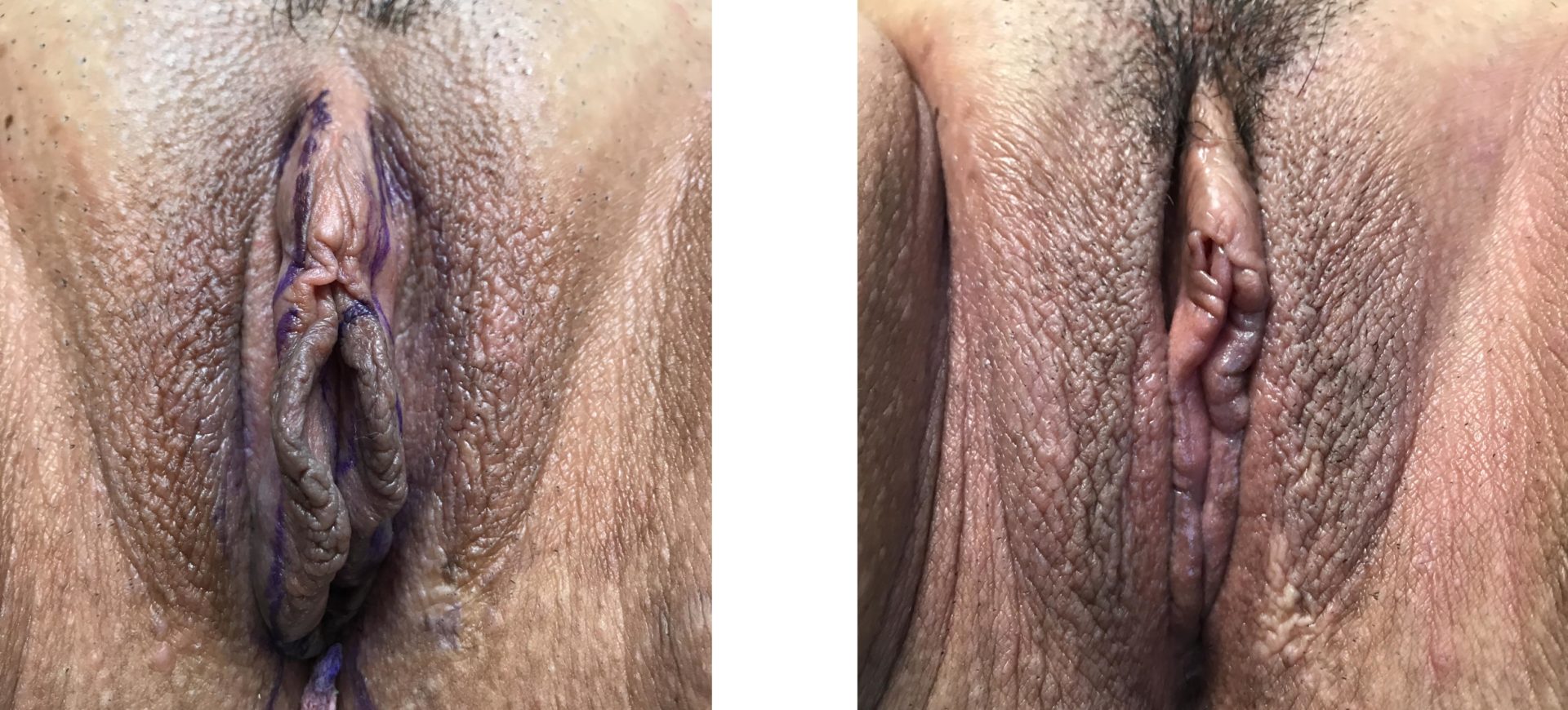 Labiaplasty Minora and Vaginoplasty