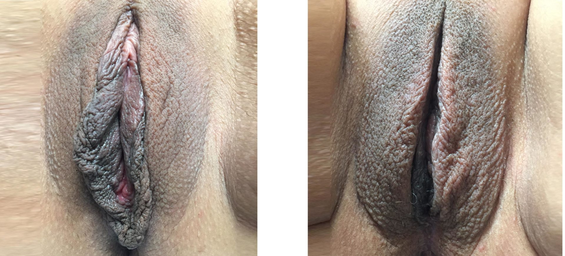 Vaginoplasty and Labiaplasty Minora