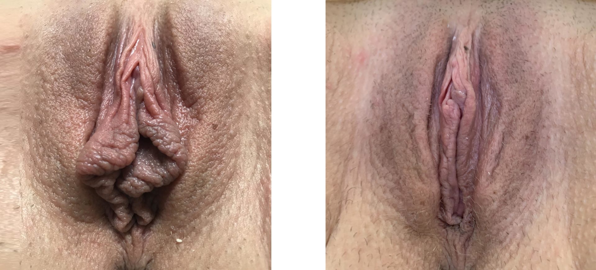 Labiaplasty Minora