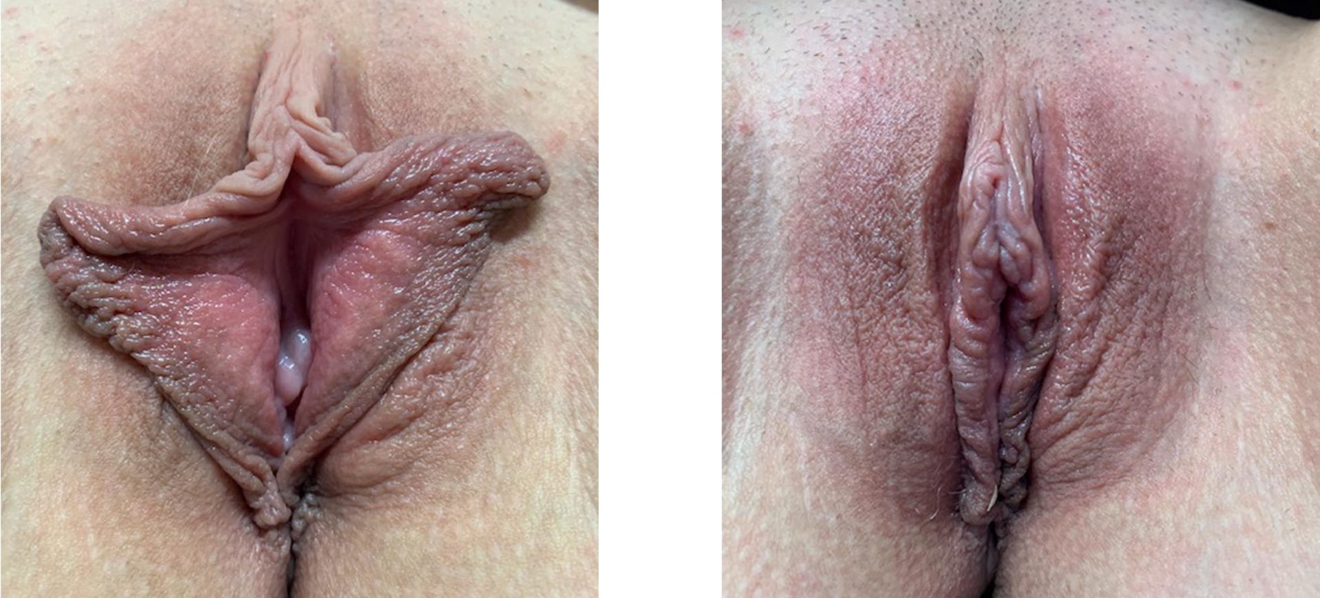 Labiaplasty Minora