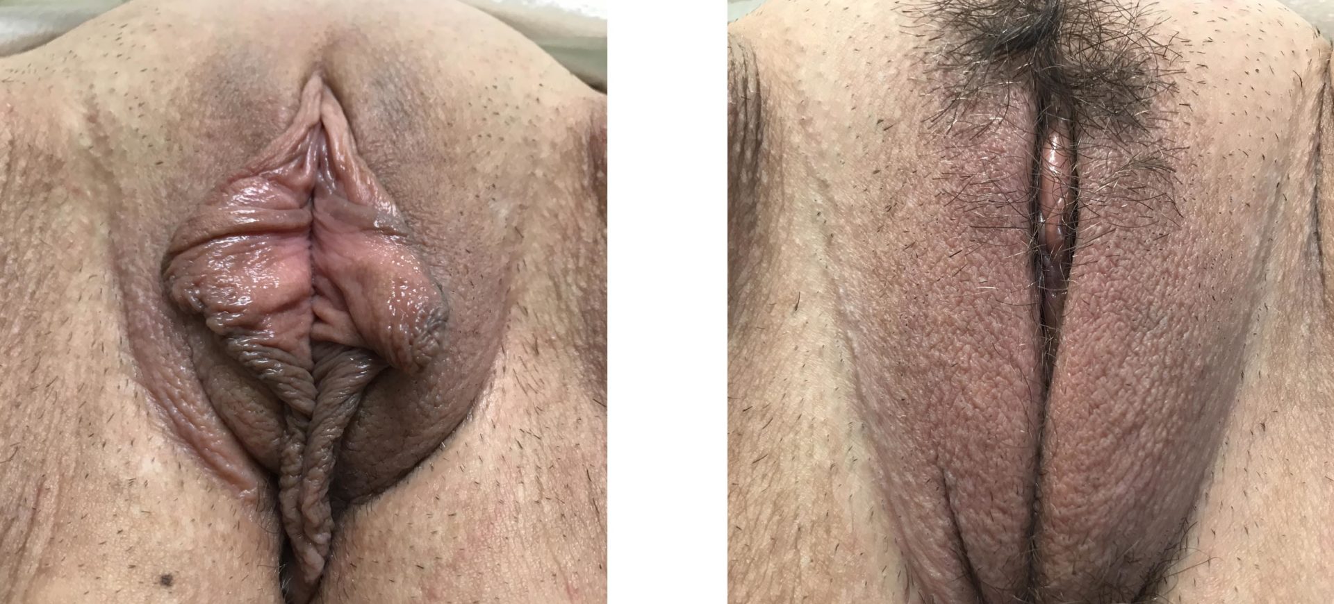 Vaginoplasty and Labiaplasty Minora