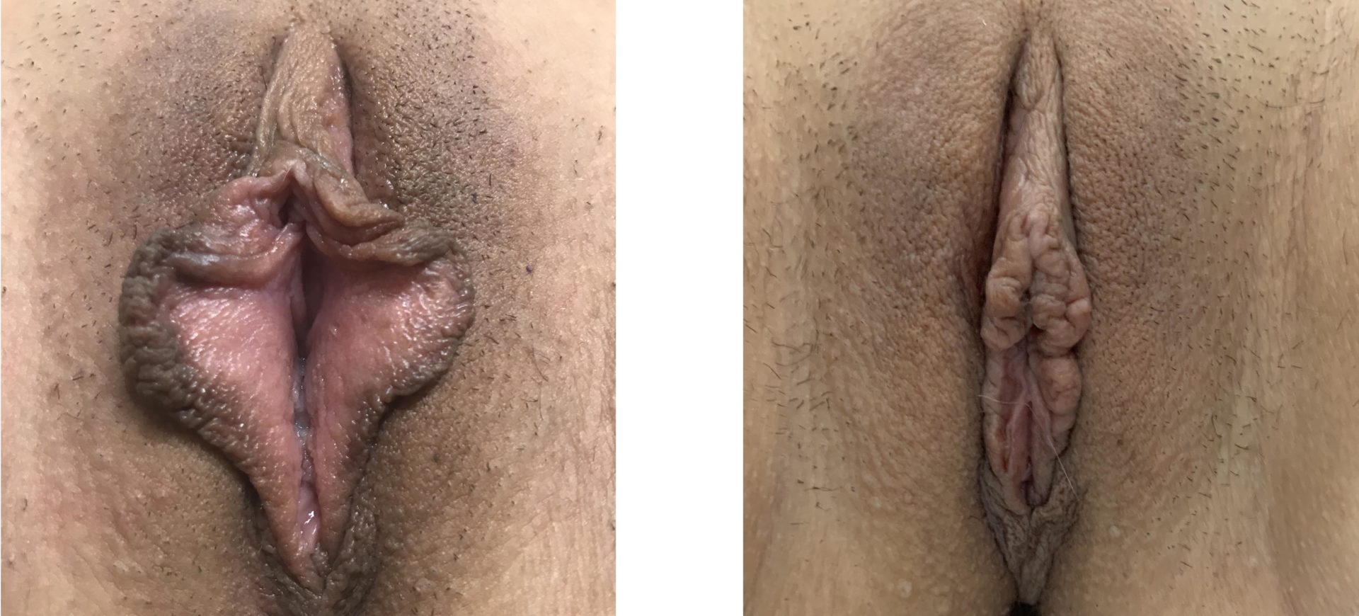Labiaplasty Minora and Clitoral hood reduction