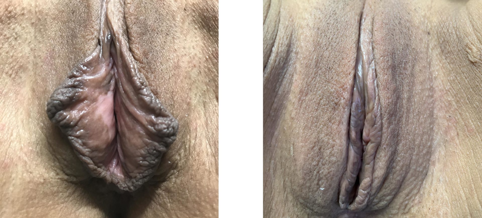 Labiaplasty Minora and Vaginoplasty