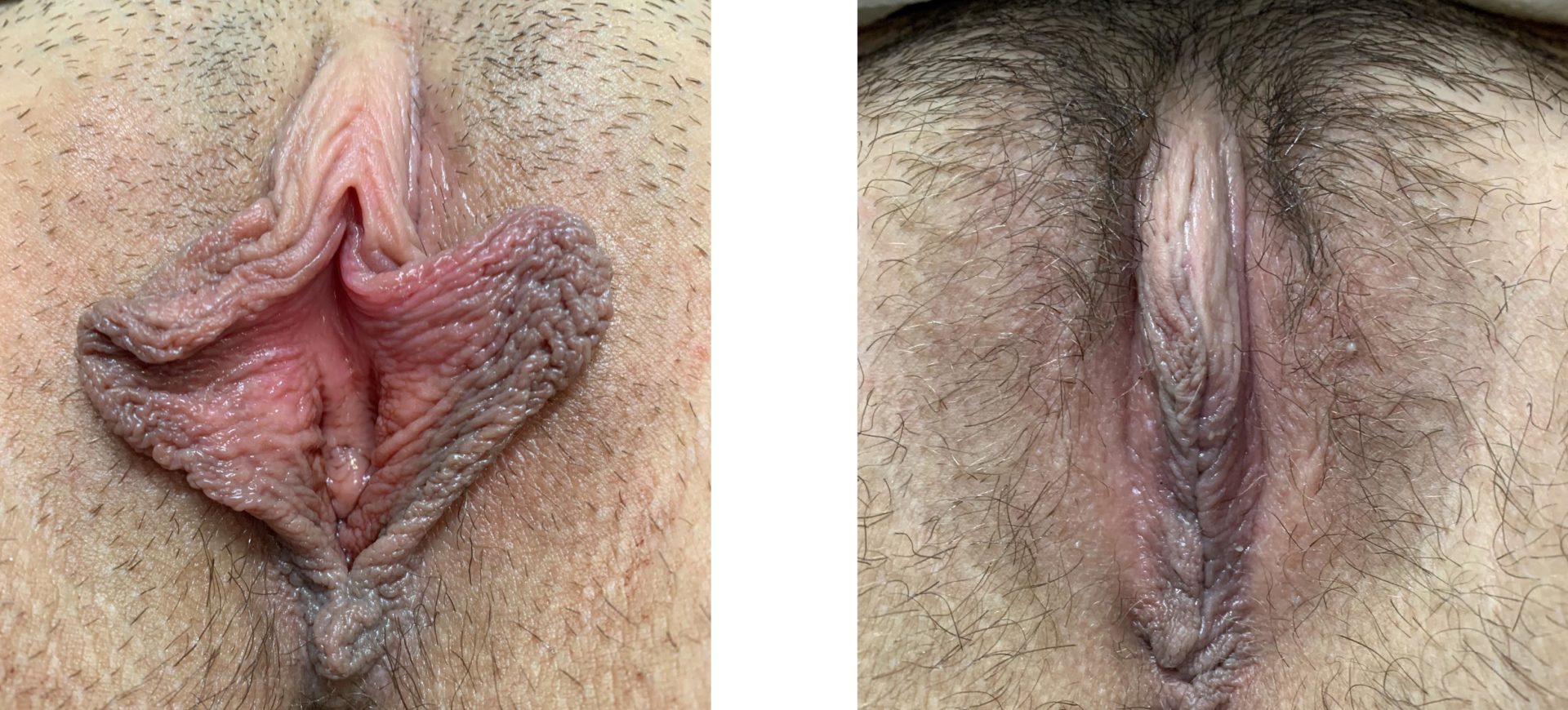 Labiaplasty Minora