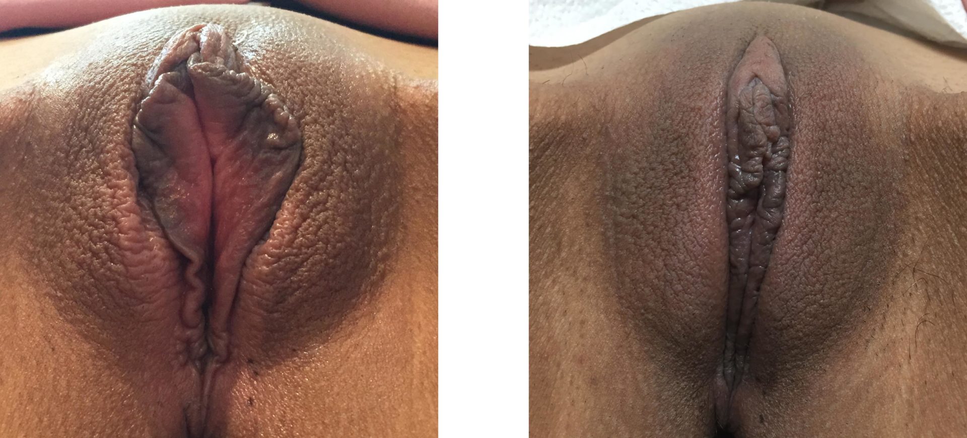 Labiaplasty Minora and Clitoral hood reduction.