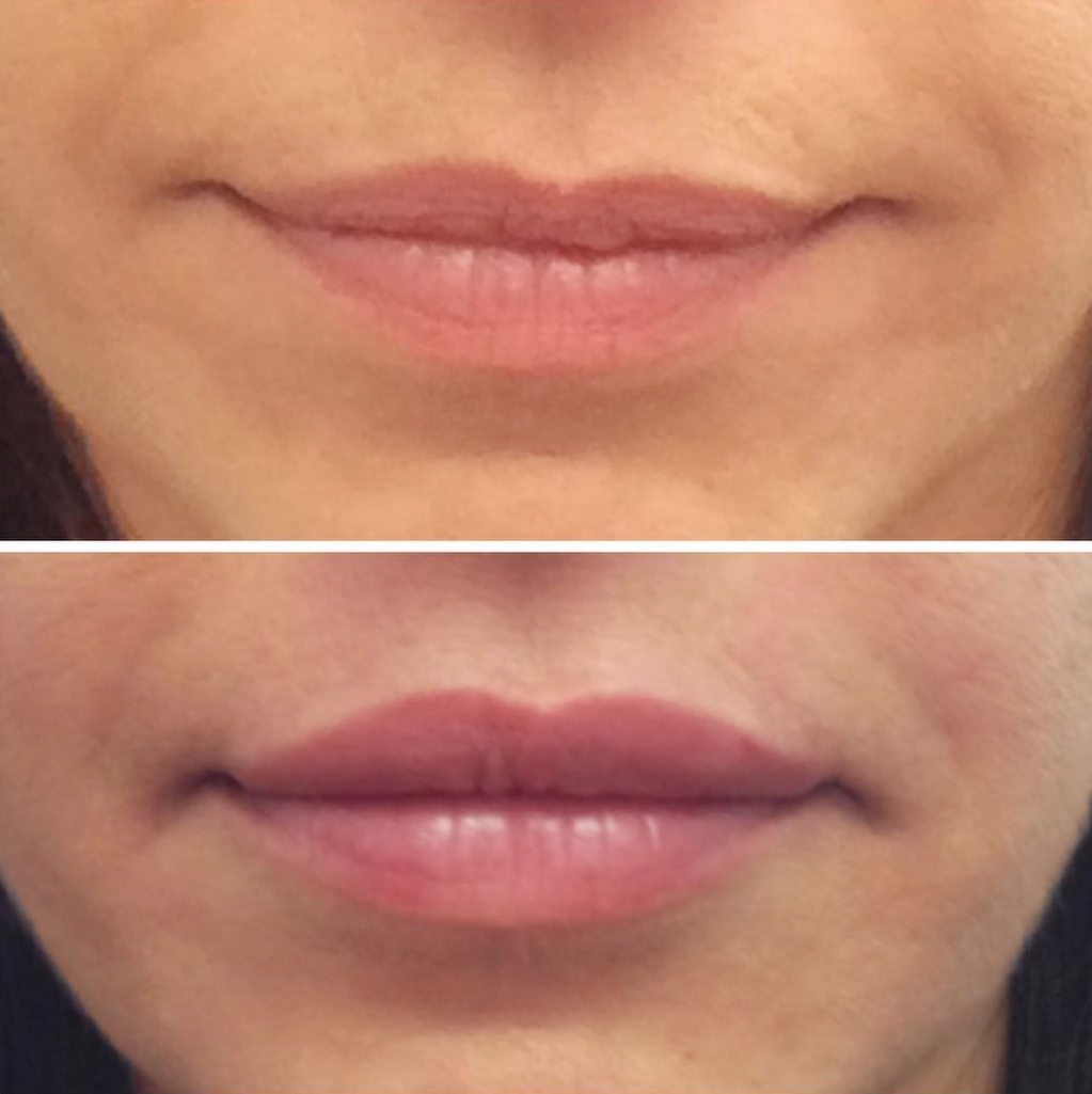 Volbella Before and after Lips