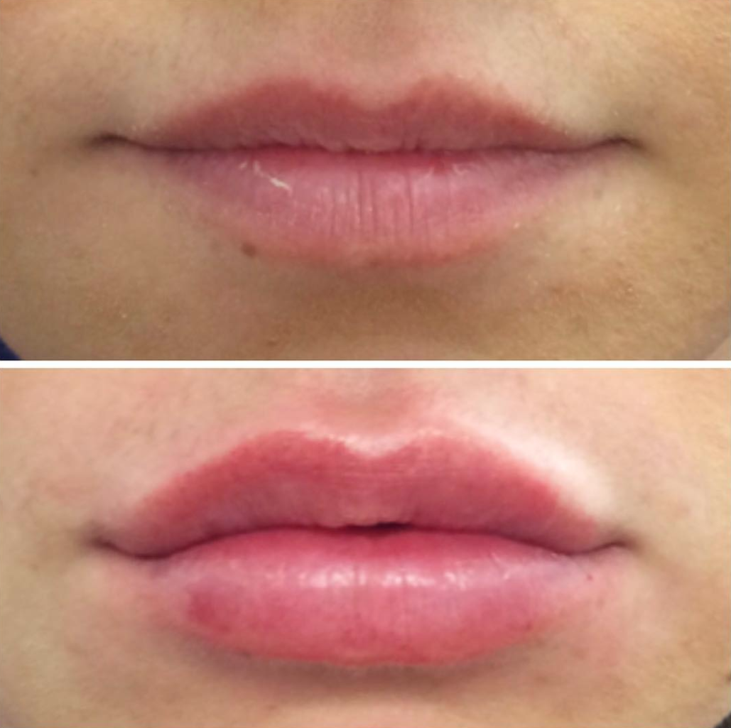 Volbella Before and after Lips Area