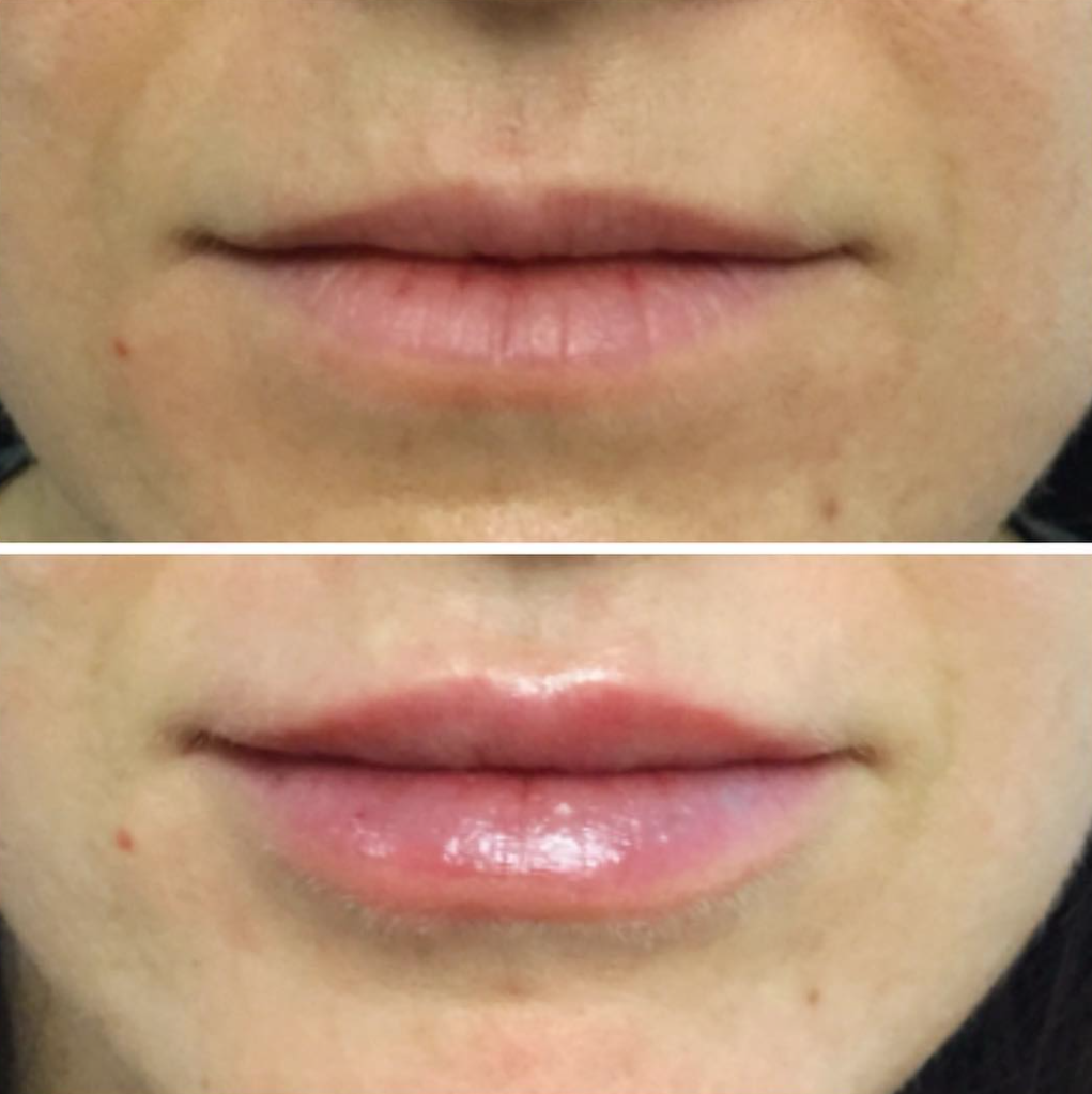 Volbella Before and after Lips Area