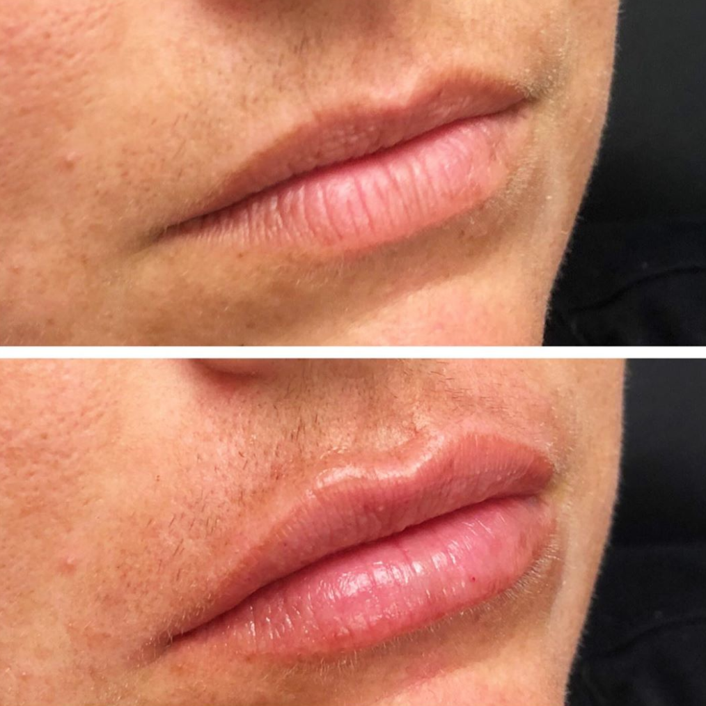 Volbella Before and after Lips Area