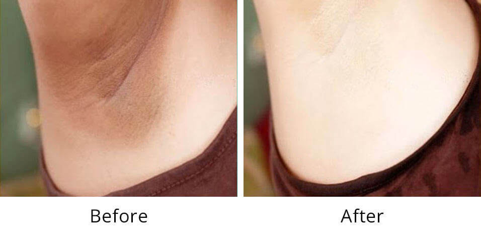 Intimate Lightening Before and After Under Arm.