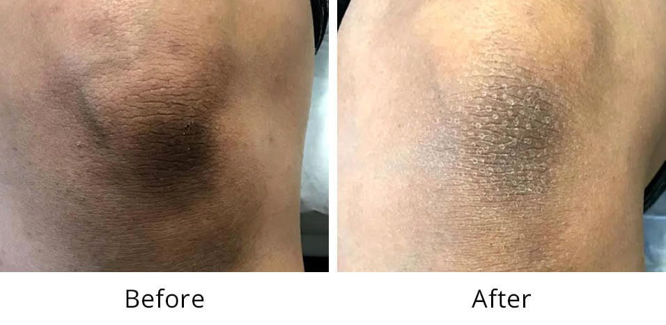 Intimate Lightening Before and After Knee