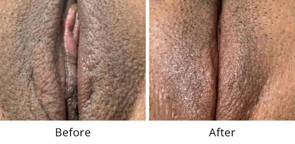 Intimate Lightening Before and After Vaginal Area