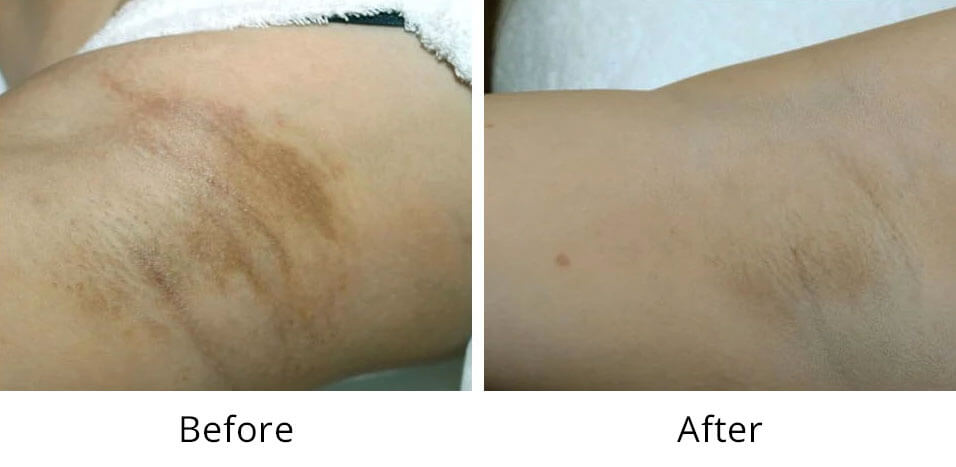 Intimate Lightening Before and After Under Arm