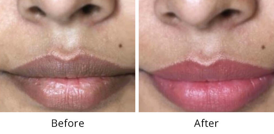 Intimate Lightening Before and After Lips.