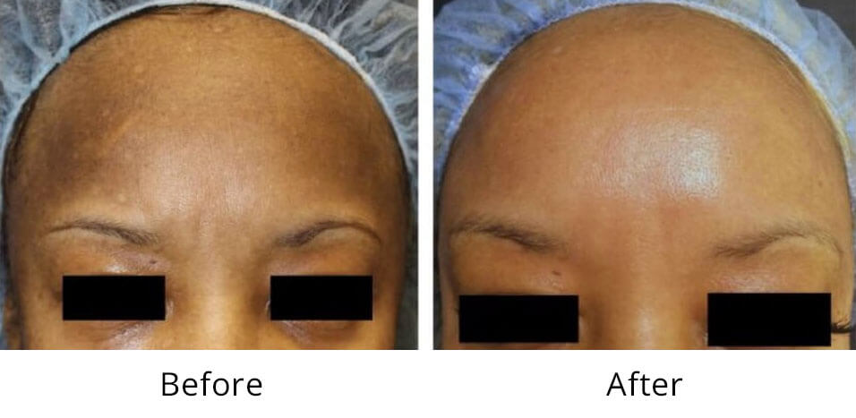 Intimate Lightening Before and After forehead