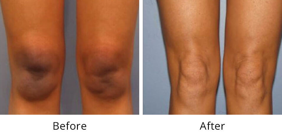 Intimate Lightening Before and After Legs