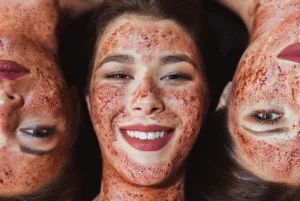 vampire facial