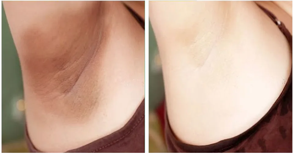 Before and after intimate lightening