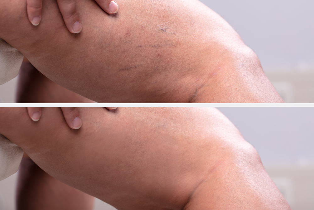 What Are Spider Veins?