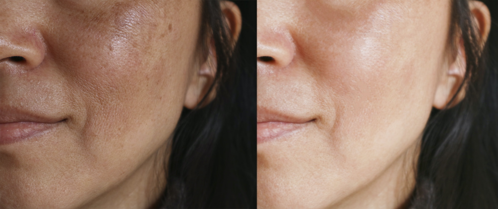 What Causes Hyperpigmentation?