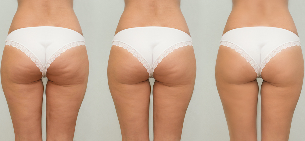 What is the Best Solution for Getting Rid of Cellulite?