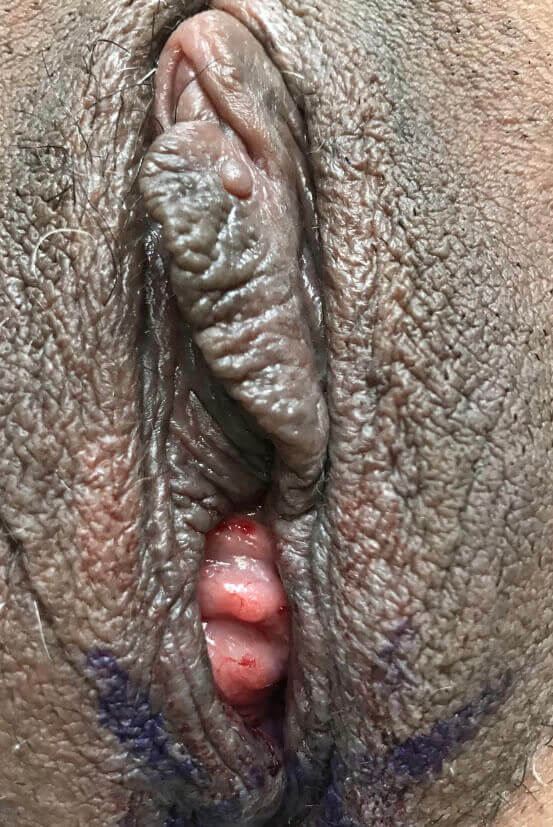 Vaginoplasty Results Photo B1