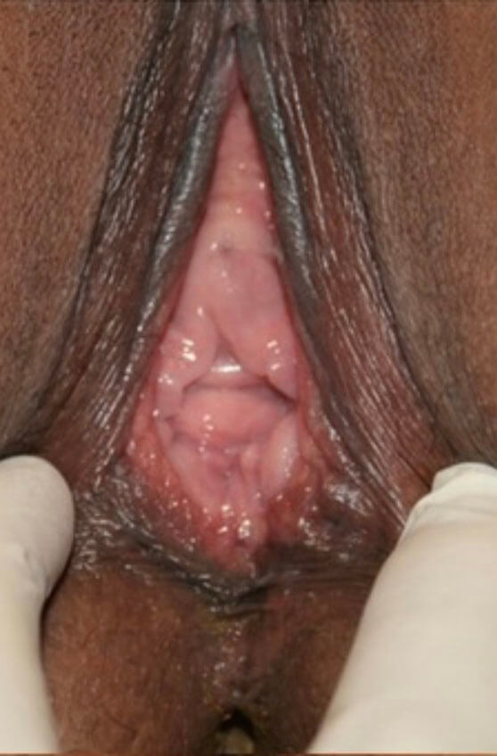 Vaginoplasty Results Photo C1-5
