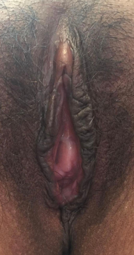 Vaginoplasty Results Photo D1-5