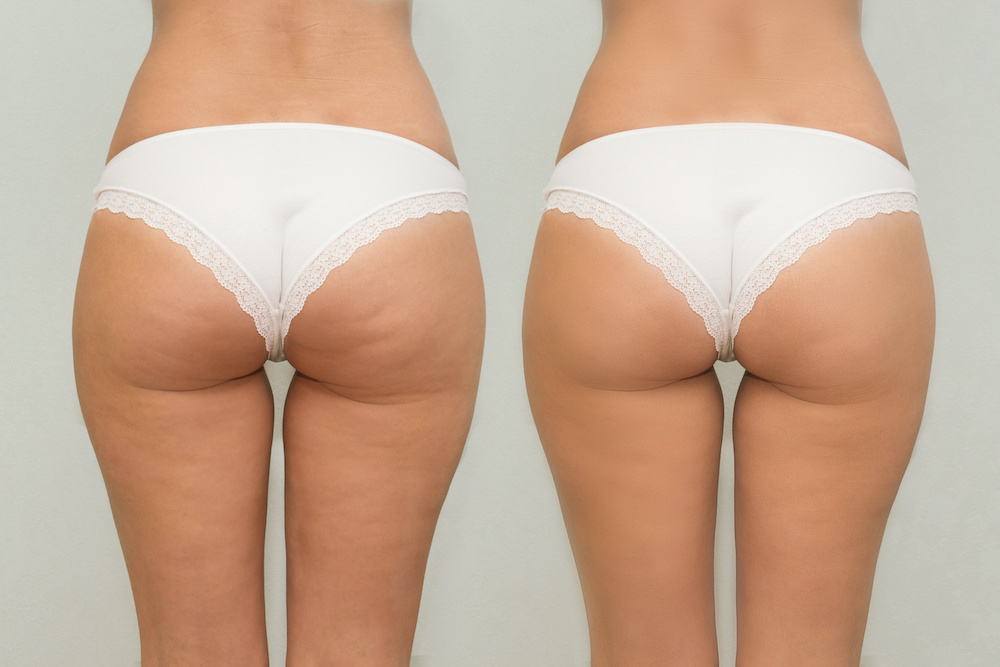 How to Get Rid of Cellulite: Surgical and Non-Surgical