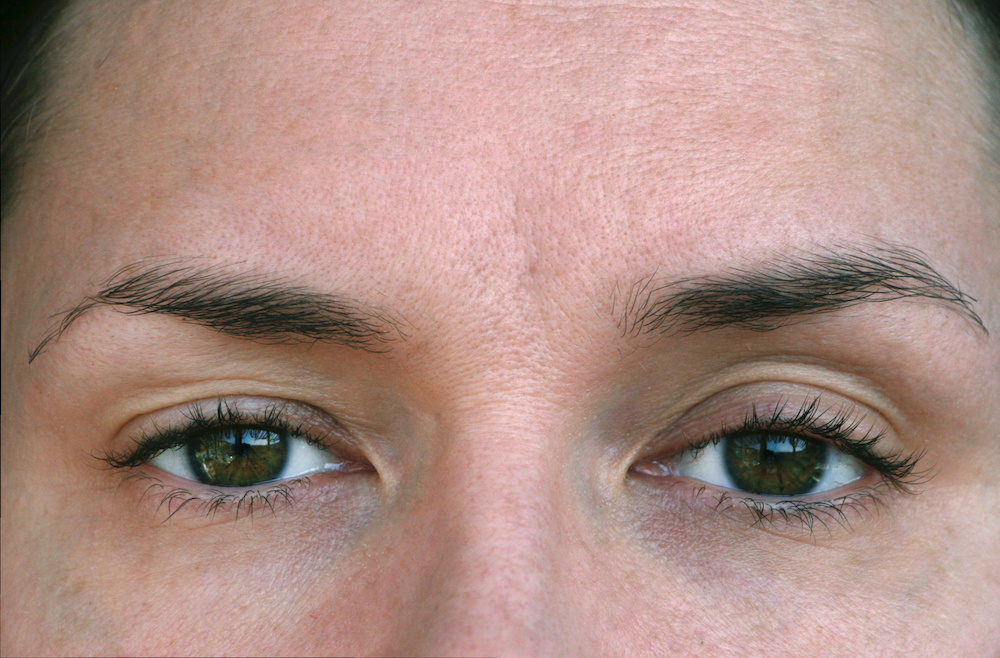 What is Ptosis?
