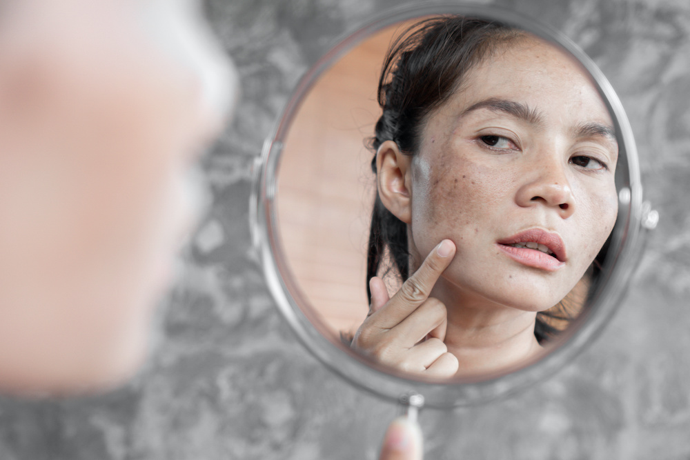 How to Differentiate Between Melasma and Hyperpigmentation?