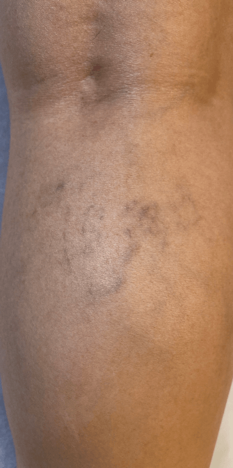 Spider Veins in Leg