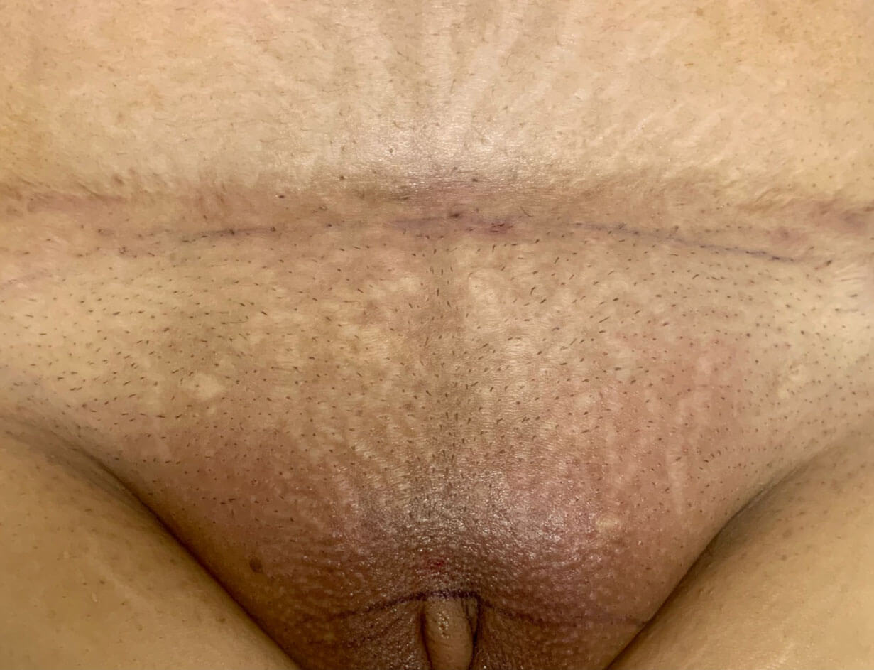 Mons Pubis Lipo Suction