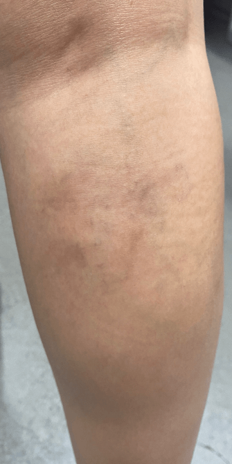 Faint Spider Veins in Leg