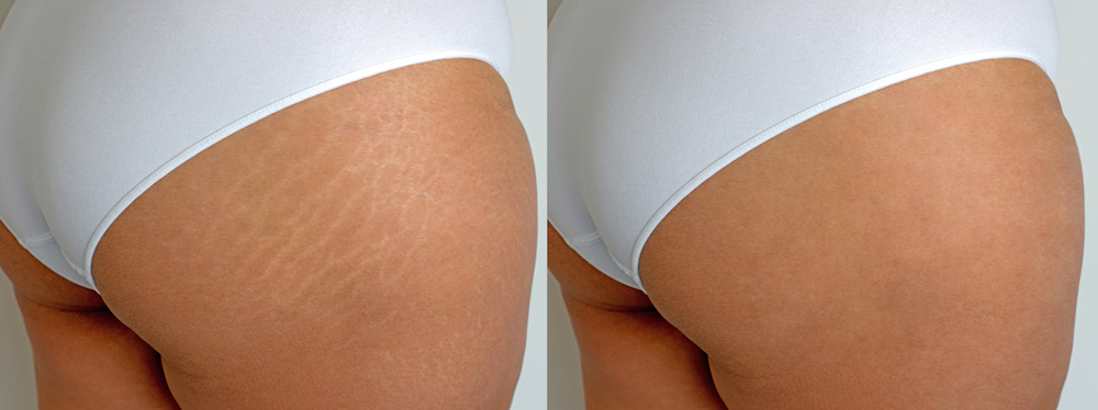 What is Better, Cream or Laser Stretch Mark Reduction? 