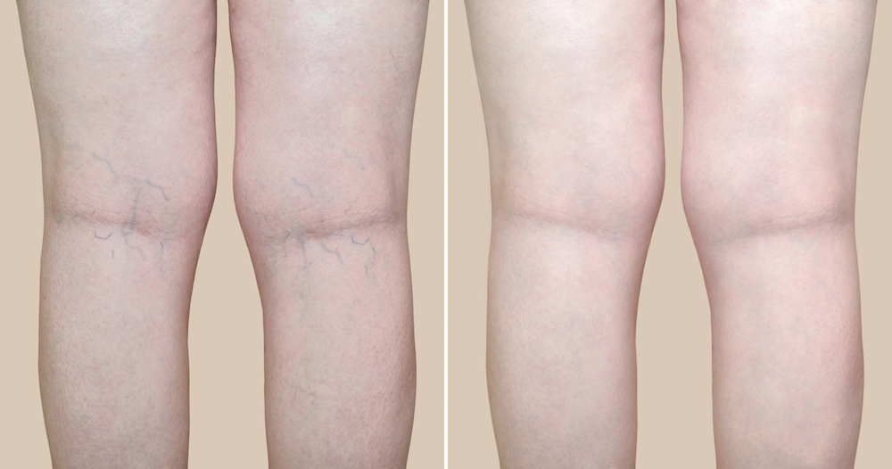 How to Treat Spider Veins