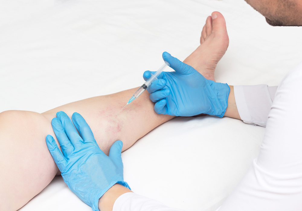 How Long Will Sclerotherapy Last?